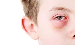 Bahar Alerjileri Gözleri Vuruyor: Uzmandan Kritik Uyarılar