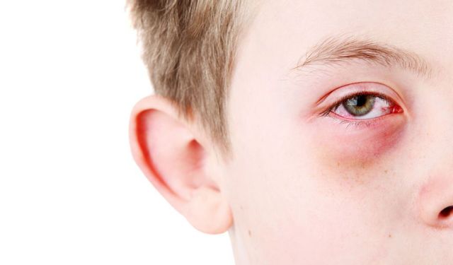 Bahar Alerjileri Gözleri Vuruyor: Uzmandan Kritik Uyarılar