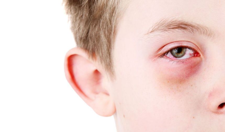 Bahar Alerjileri Gözleri Vuruyor: Uzmandan Kritik Uyarılar